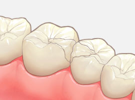 コンポジットレジン修復