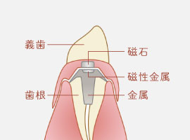 アタッチメント義歯