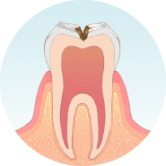 虫歯が神経に近くなり、冷たいものがしみます