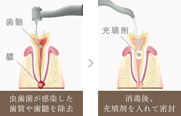 虫歯菌が感染した歯質や歯髄を除去→消毒後、充填剤を入れて密封