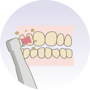 歯のクリーニング歯垢・歯石の除去