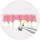 歯間や歯面をクリーニング