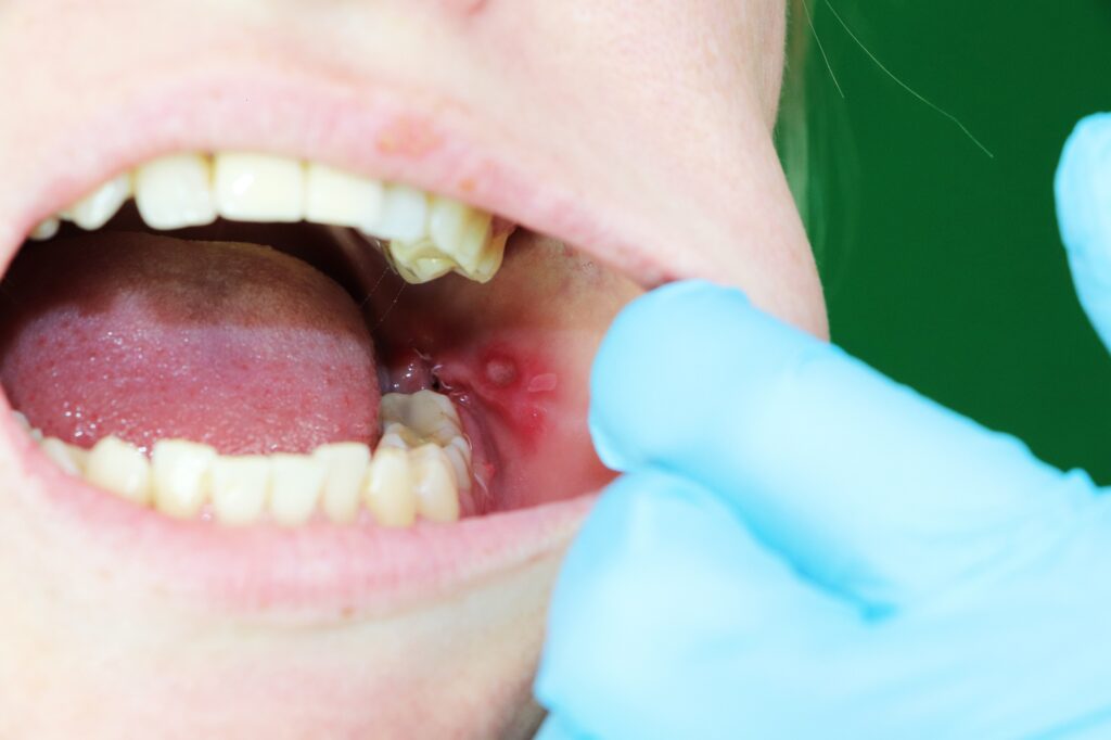 頬っぺたの内側に口内炎ができ歯科で診察を受けている女性