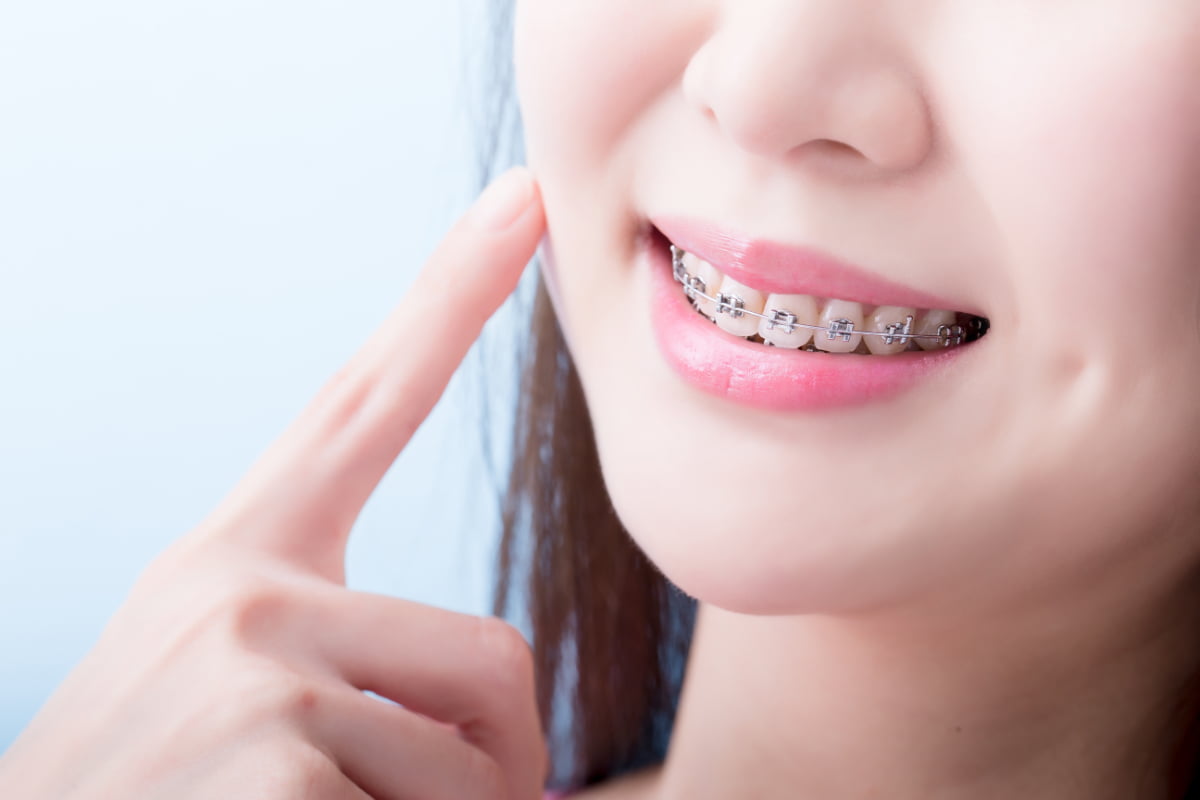 ワイヤー矯正で歯並びを治療する女性