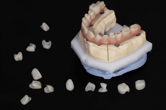 歯の模型とクラウンのイメージ