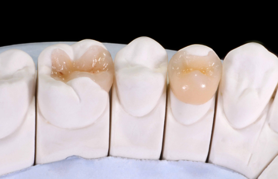 インレーのイメージ