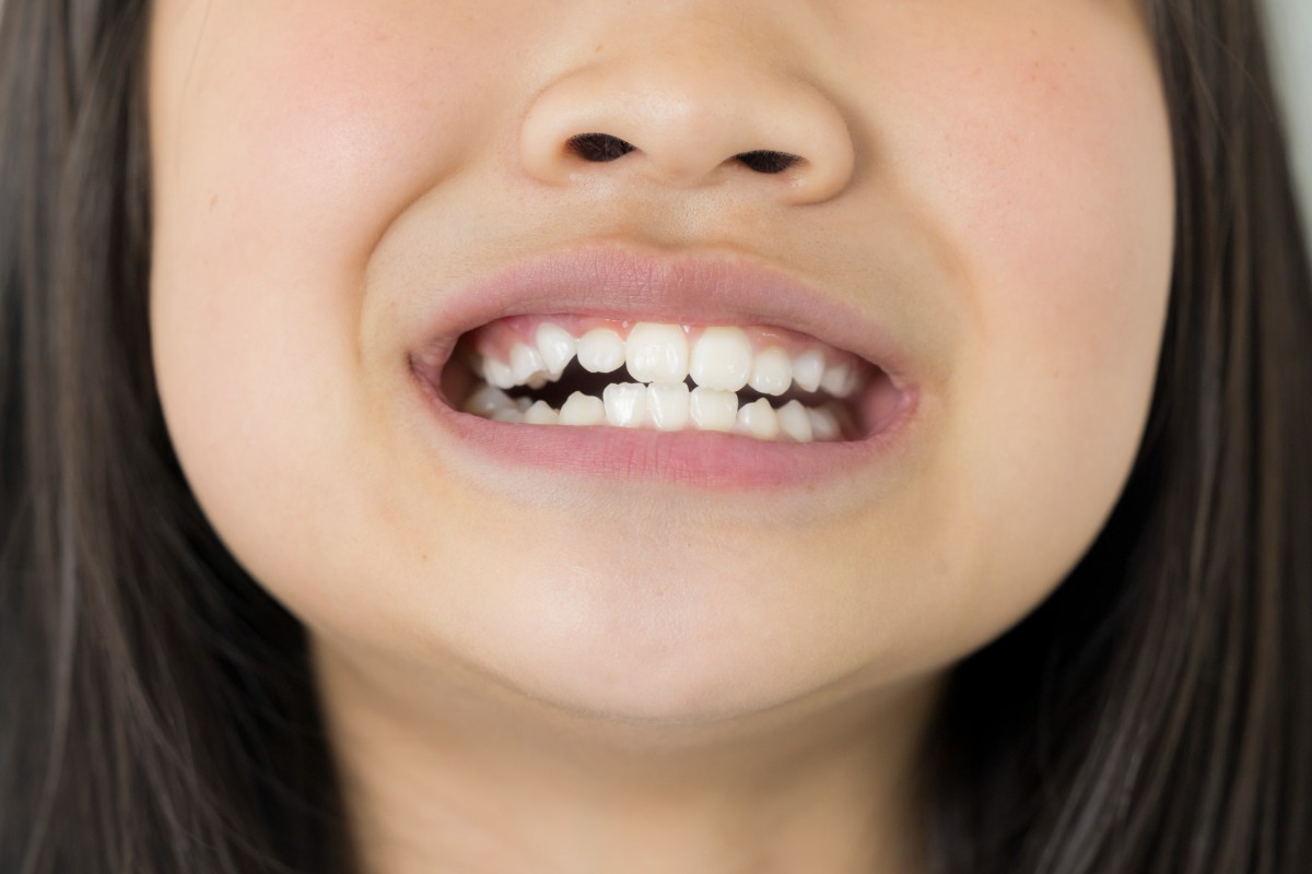 矯正を検討したほうがよい歯並びの子ども