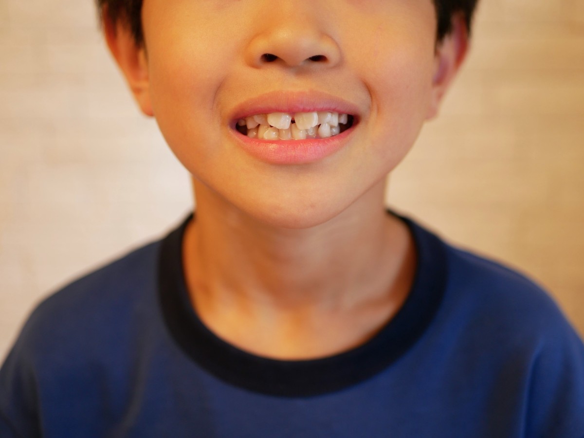 歯並びの悪い子ども
