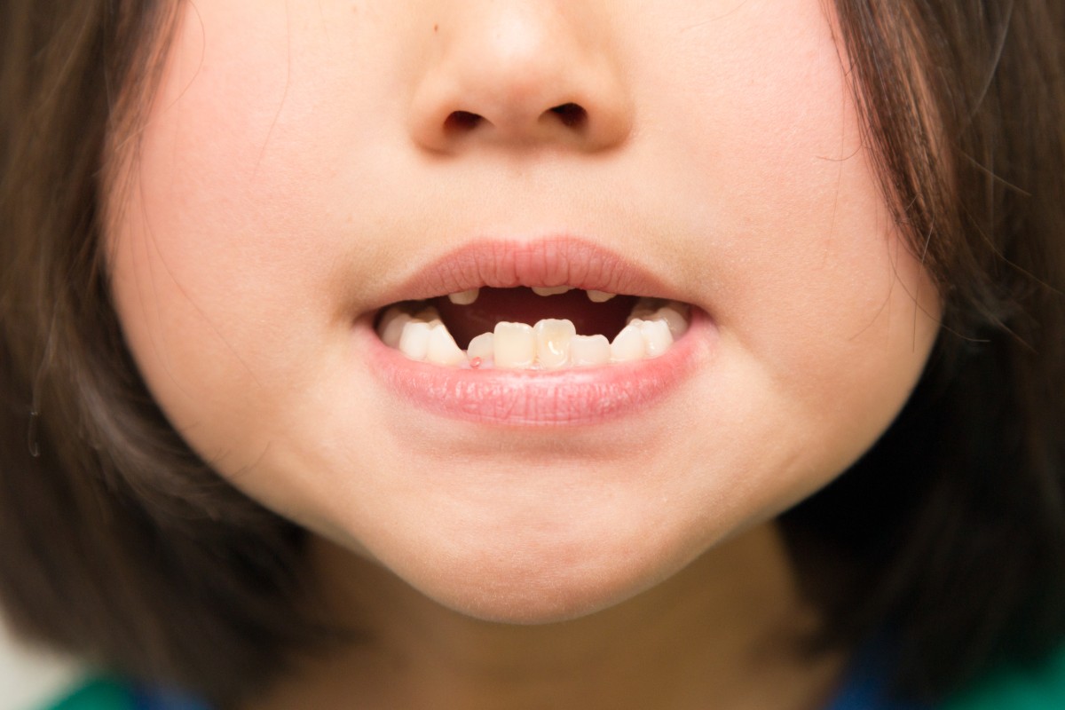 歯並びの悪い子ども